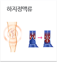 하지정맥류