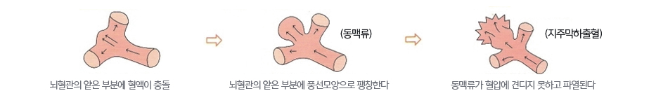 동맥류와 지주막하출혈 이미지