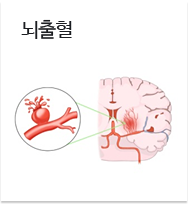 뇌출혈