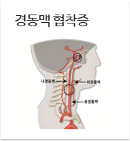 경동맥 협착증