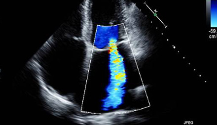 승모판막 폐쇄 부전증 초음파사진