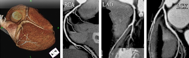 심장혈관 CT검사 