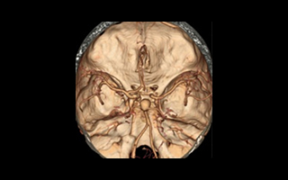 CT Angio (혈관조영검사)