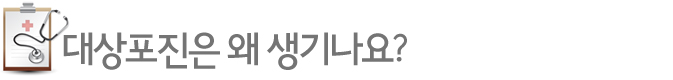 대상포진은 왜 생기나요?