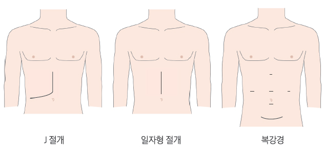 j절개 일자형절개 복강경