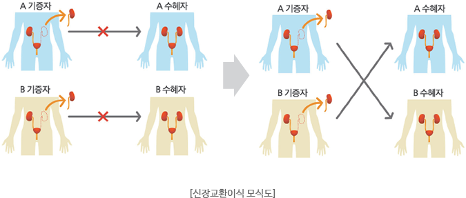 신장교환이식 모식도