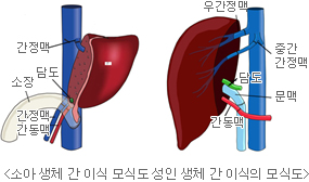 간 이식