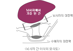 간 이식