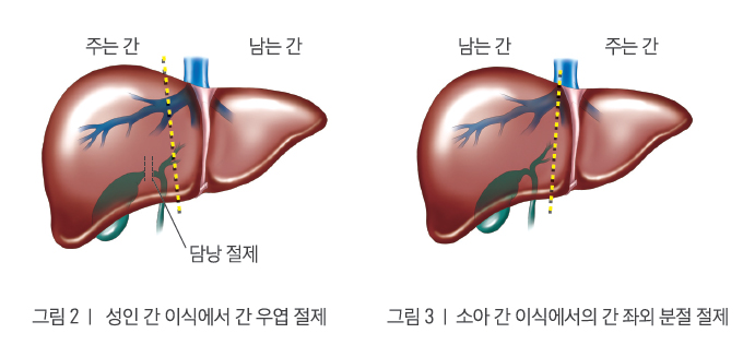 그림2 성인 간 이식에서 간 우엽 절제/ 그림3 소아 간 이식에서의 간 좌외 분절 절제