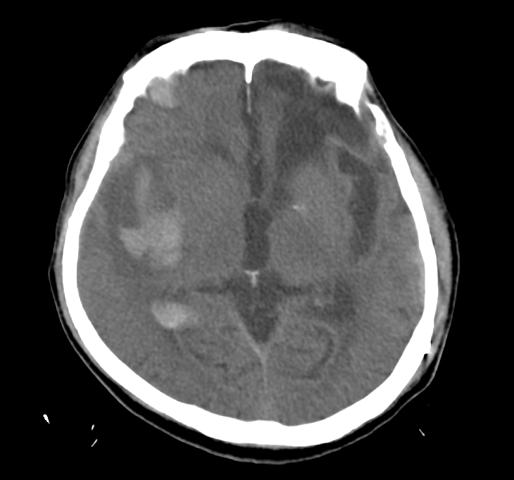 Stroke.png Stroke.png