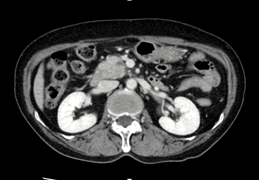 Pancreatic cancer(1).png