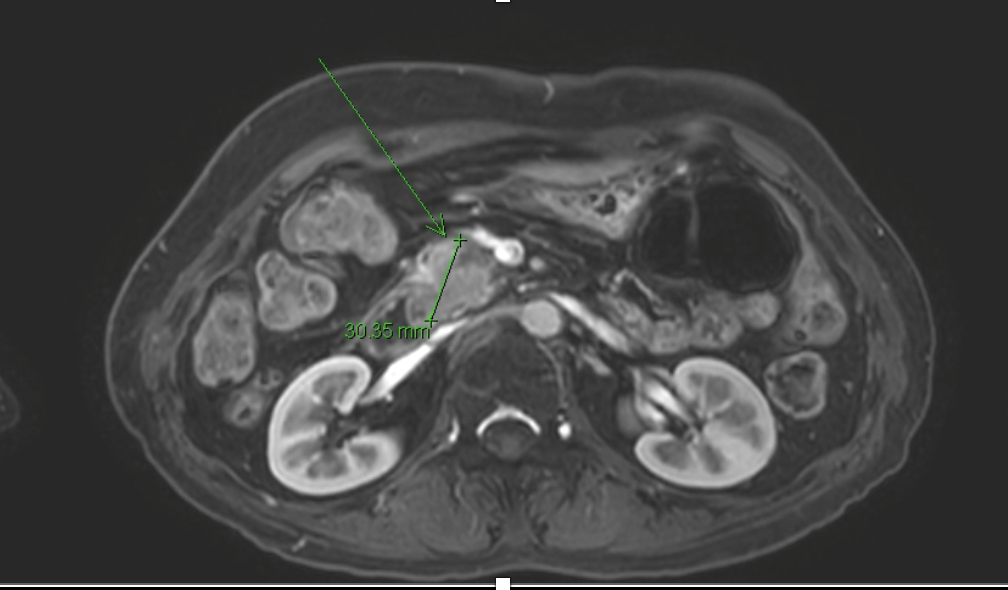 Pancreatic cancer(2).png