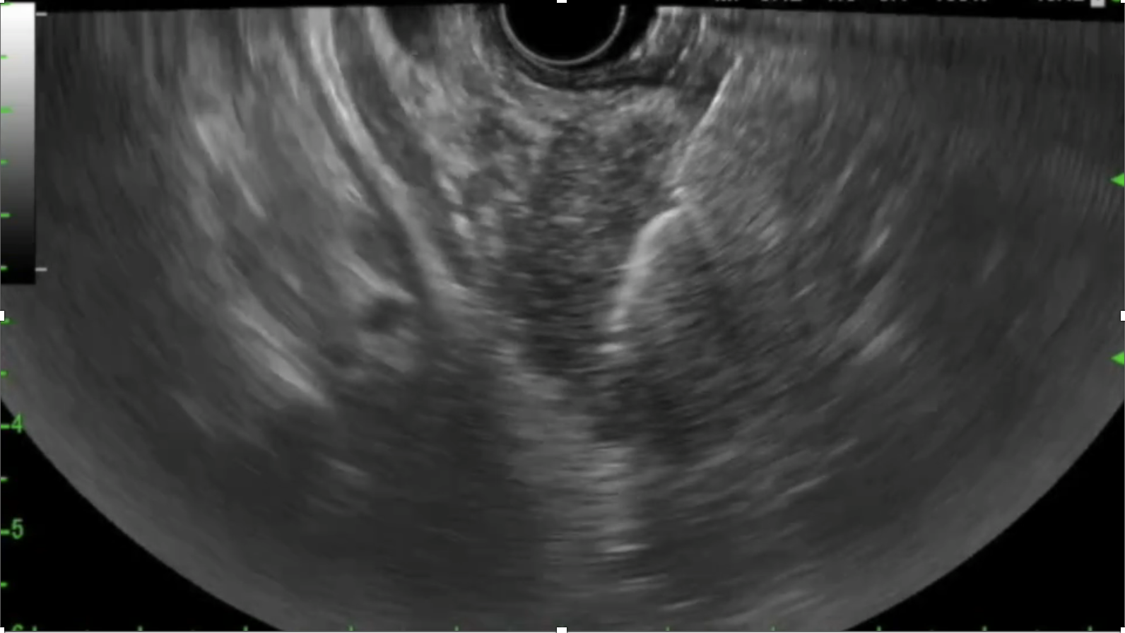 Pancreatic cancer(3).png