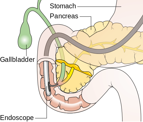 Bile duct cancer(1).png Bile duct cancer(1).png