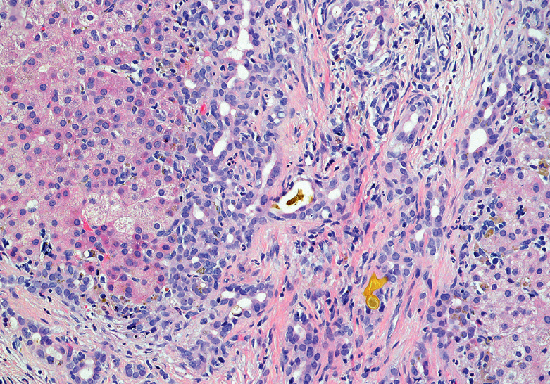 Biliary atresia(2).png Biliary atresia(2).png