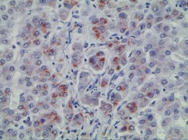 Wilson disease(2).png Wilson disease(2).png