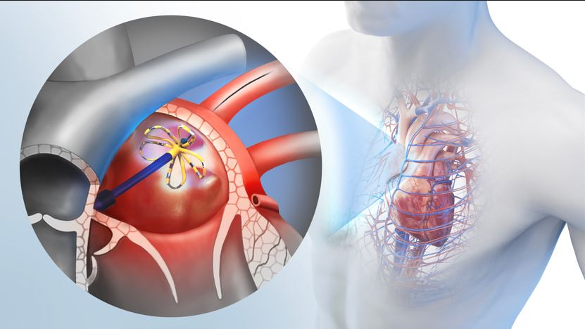 SMC Successfully Performs the Latest Atrial Fibrillation Treatment, &ldquo;Pulsed Field Ablation&rdquo;.png