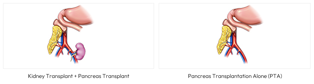 kidney transplant, PTA.png