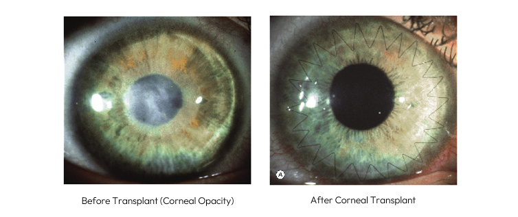 Corneal Transplant.png Corneal Transplant.png